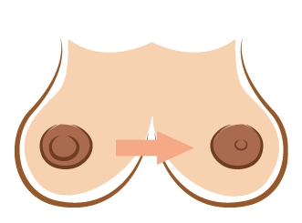 乳頭整形