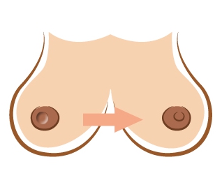 乳頭整形