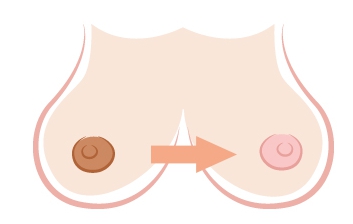 乳頭整形