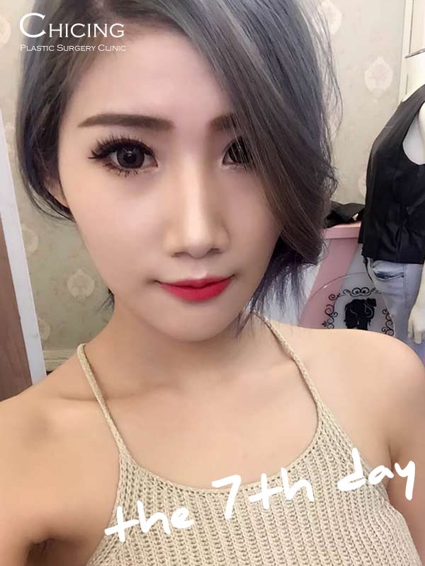 墊下巴手術