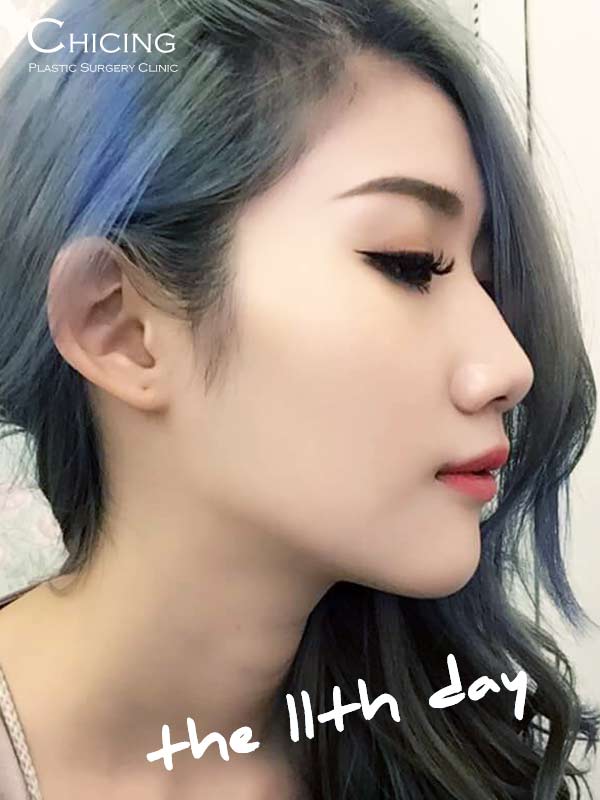 人工骨墊下巴