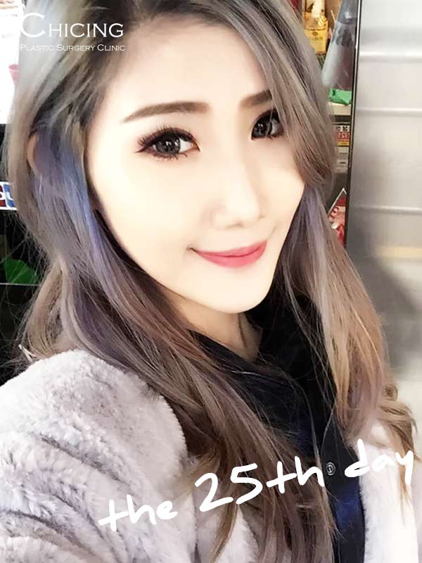 下巴整型