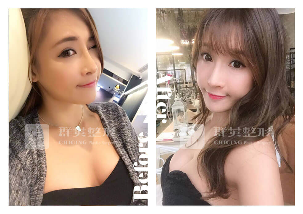 曼托光滑面隆胸_陳廣得醫師_台北隆胸