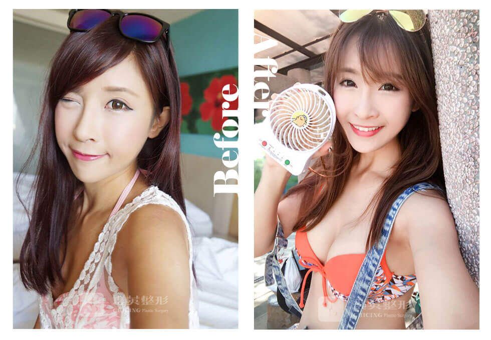 曼托光滑面隆胸_陳廣得醫師_台北隆胸