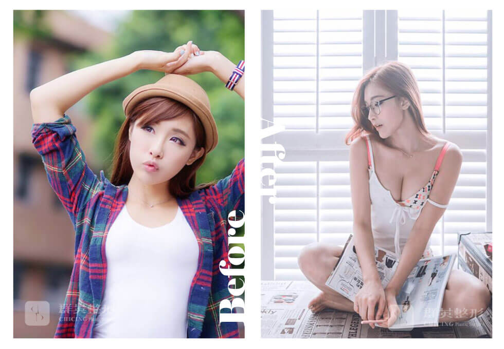 曼托光滑面隆胸_陳廣得醫師_台北隆胸