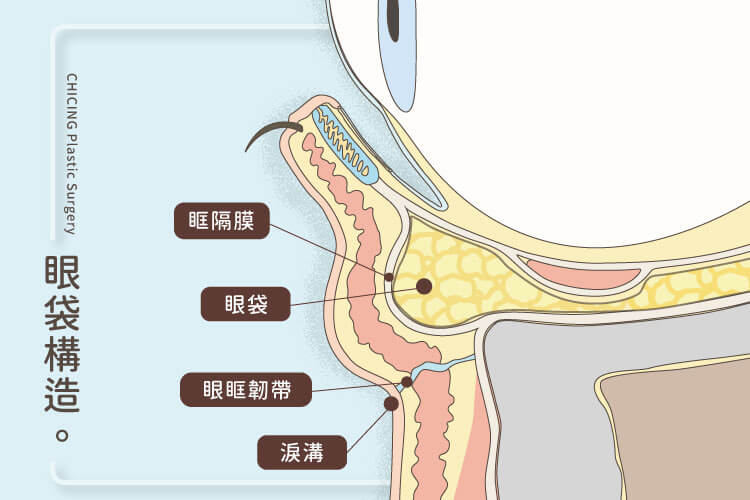 消除眼袋_洪章桂醫師