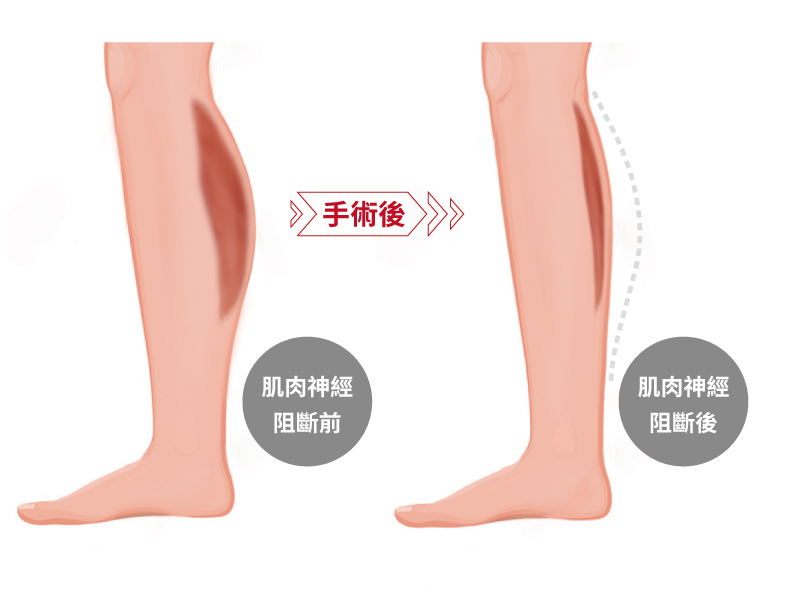 陳廣得醫師_小腿神經截斷術