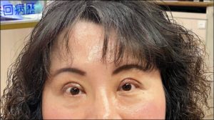 群英整形_王冠穎醫師_提眼肌_自由時報
