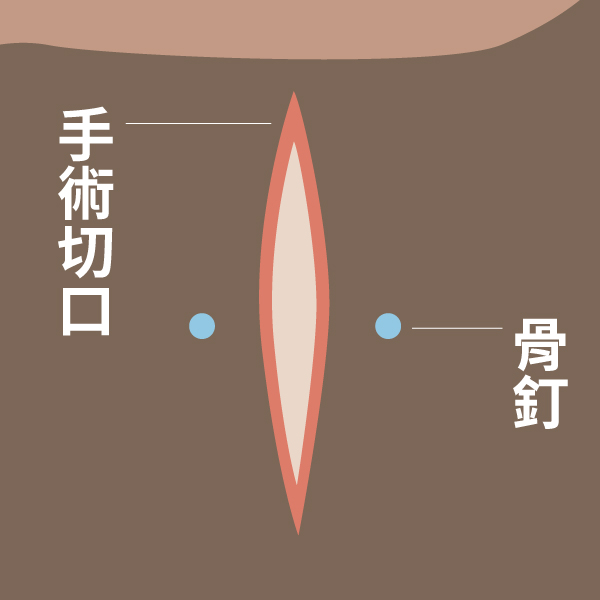 群英整形外科_複合式前額拉皮