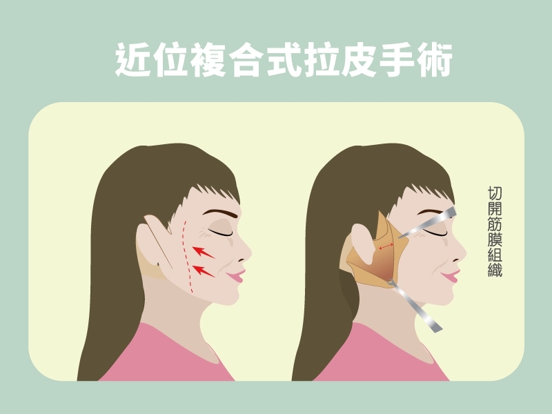 台中群英_林雍球醫師_近位中下臉拉皮109