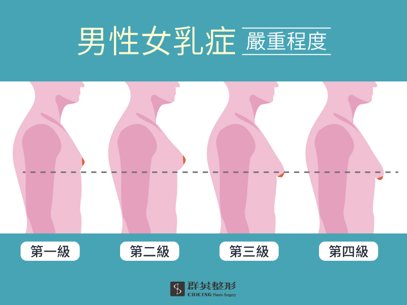 高雄群英_蘇毓彬醫師_男性女乳症01