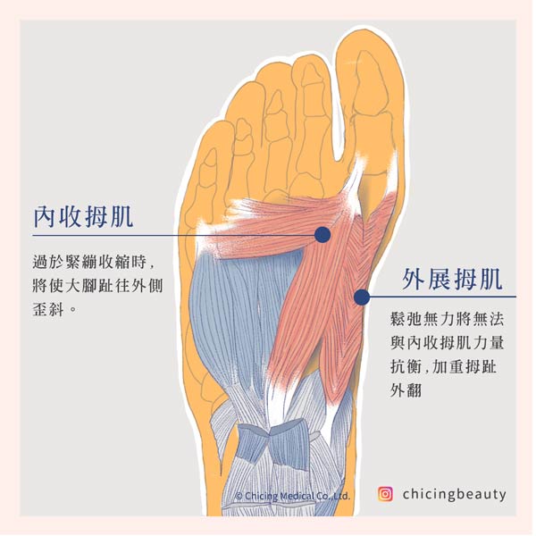 拇趾外翻手術_小黑醫師_陳建璋醫師
