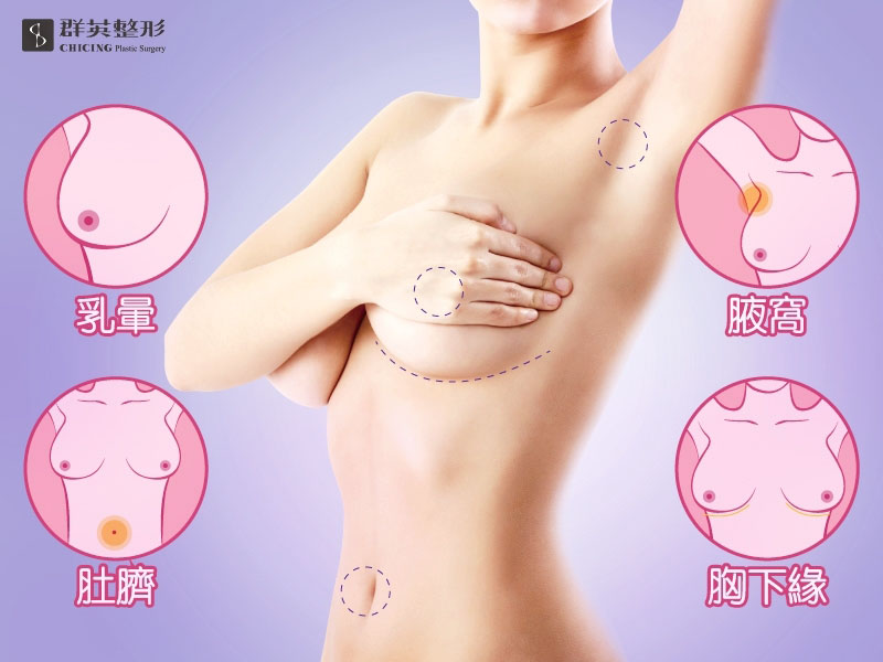 群英整形_王冠穎醫師_隆乳懶人包