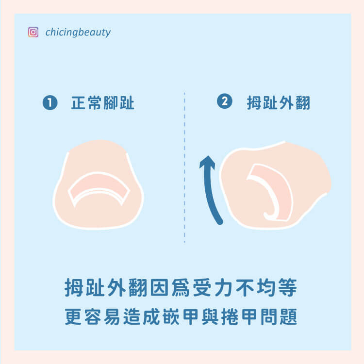 拇趾外翻_陳建璋醫師_小黑醫師