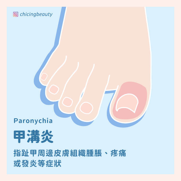 甲溝炎_陳建璋醫師_小黑醫師