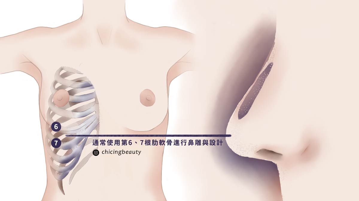群英整形_台中隆鼻、台北隆鼻、高雄隆鼻_隆鼻失敗_二次隆鼻_隆鼻重修