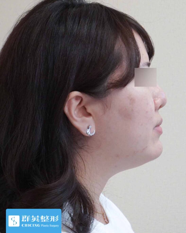 高雄群英_蘇毓彬醫師_雙下巴抽脂13