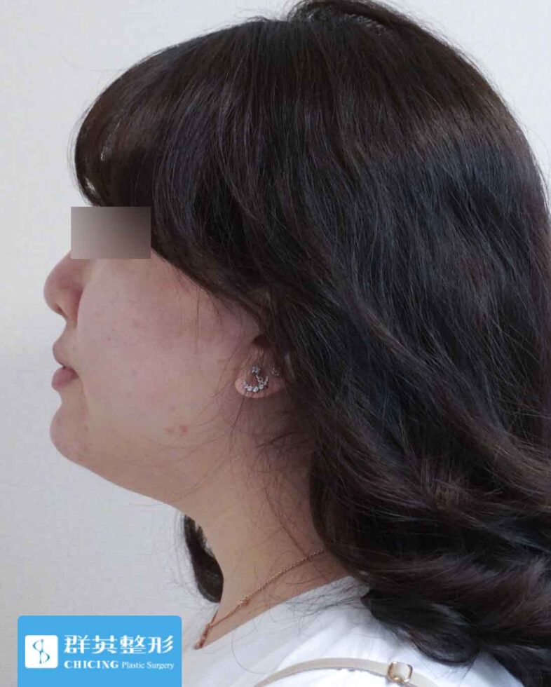 高雄群英_蘇毓彬醫師_雙下巴抽脂11