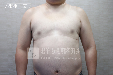 台中群英_林雍球醫師_男性女乳症11