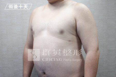 台中群英_林雍球醫師_男性女乳症10