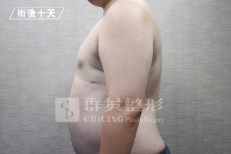 台中群英_林雍球醫師_男性女乳症09