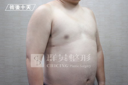 台中群英_林雍球醫師_男性女乳症08