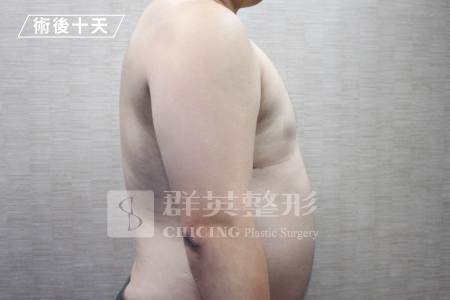 台中群英_林雍球醫師_男性女乳症07