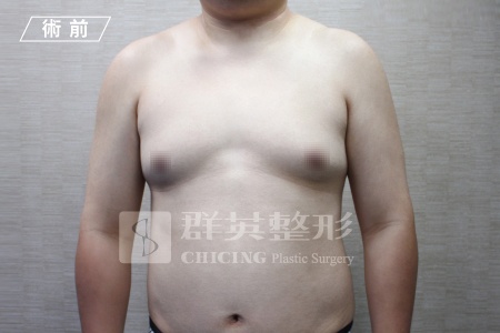 台中群英_林雍球醫師_男性女乳症16