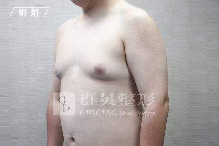 台中群英_林雍球醫師_男性女乳症15