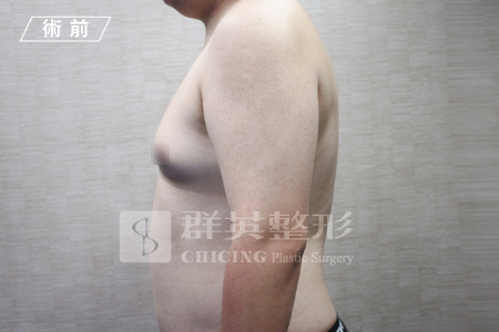 台中群英_林雍球醫師_男性女乳症14