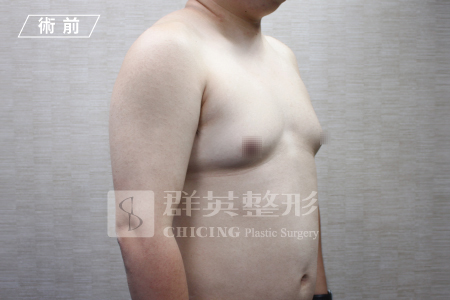 台中群英_林雍球醫師_男性女乳症13