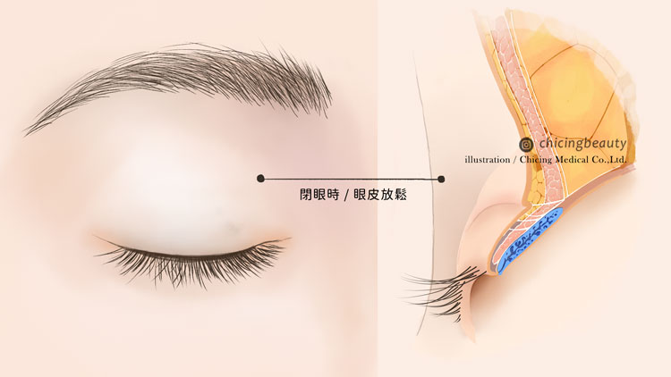 縫雙眼皮失敗_眼皮重修_陳大正醫師_台北整形
