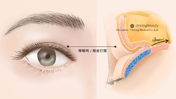 縫雙眼皮失敗_眼皮重修_陳大正醫師_台北整形