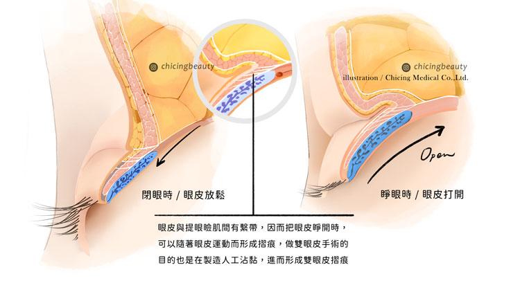 縫雙眼皮失敗_眼皮重修_陳大正醫師