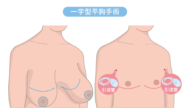 洪章桂醫師_平胸手術