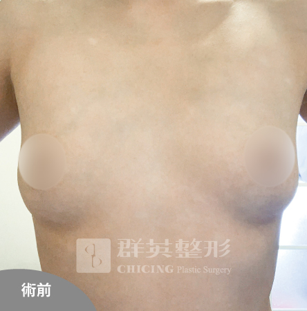 高雄群英_姚勝發醫師_光滑面果凍隆乳46