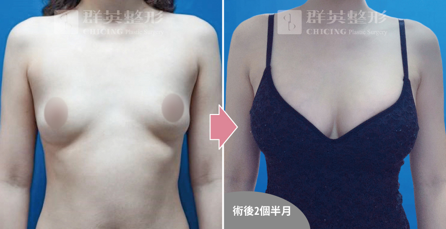 高雄群英_姚勝發醫師_光滑面果凍隆乳03