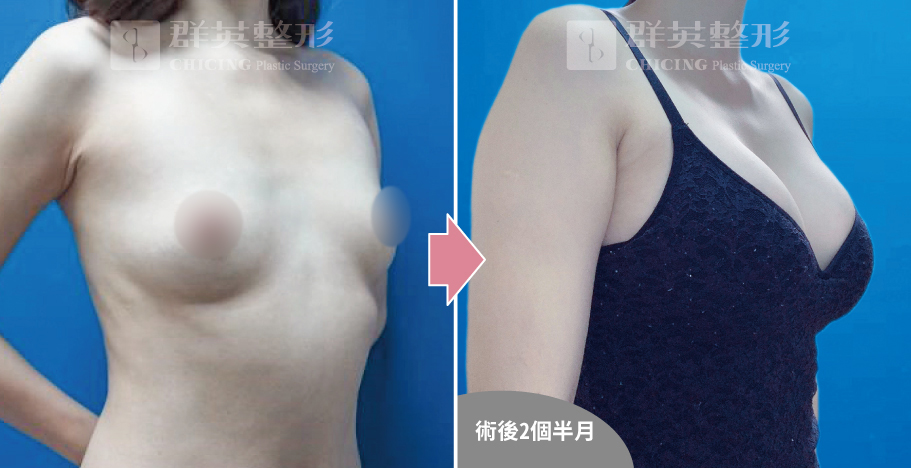 高雄群英_姚勝發醫師_光滑面果凍隆乳11