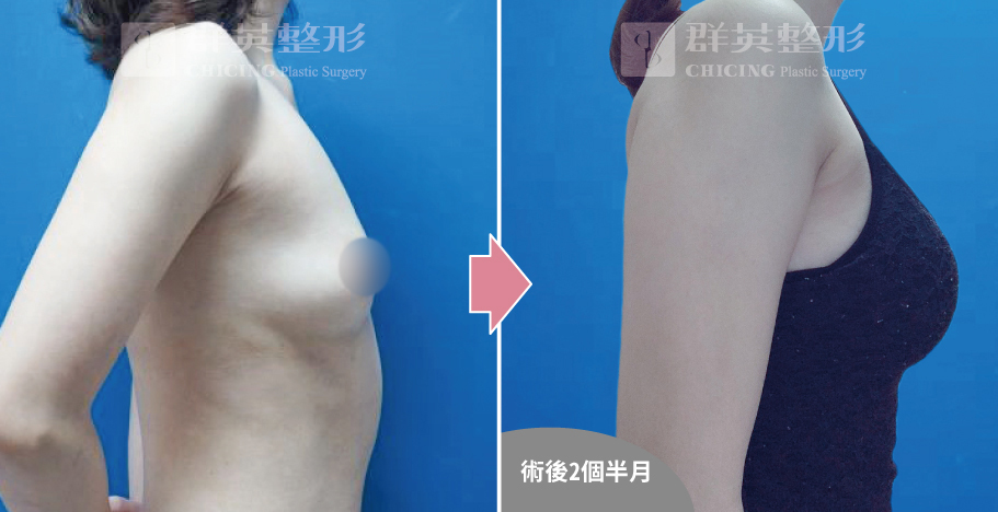 高雄群英_姚勝發醫師_光滑面果凍隆乳10