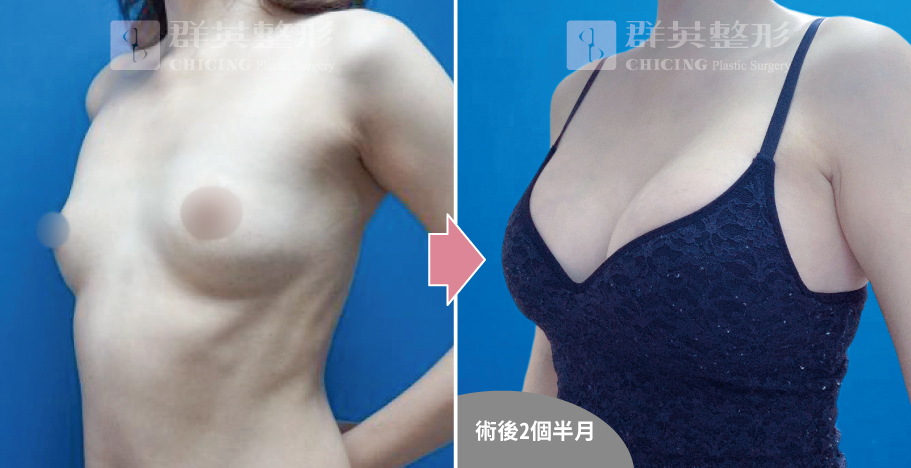 高雄群英_姚勝發醫師_光滑面果凍隆乳09