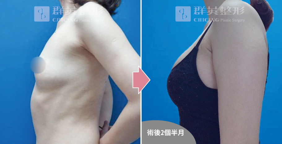 高雄群英_姚勝發醫師_光滑面果凍隆乳08