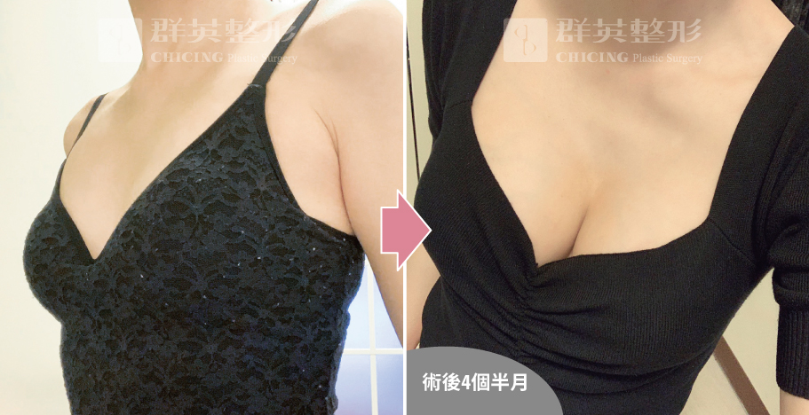 高雄群英_姚勝發醫師_光滑面果凍隆乳07