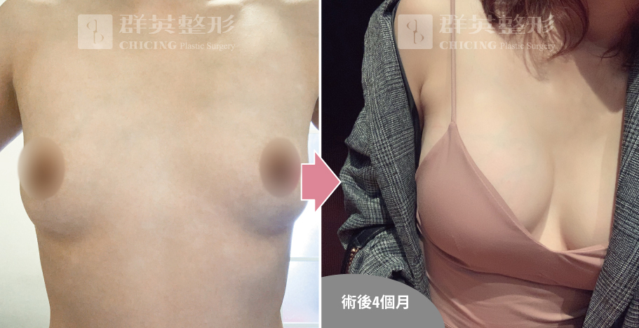 高雄群英_姚勝發醫師_光滑面果凍隆乳01