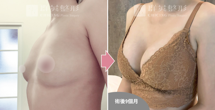 高雄群英_姚勝發醫師_光滑面果凍隆乳02