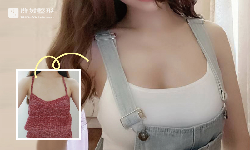 陳廣得醫師_魔滴隆乳案例