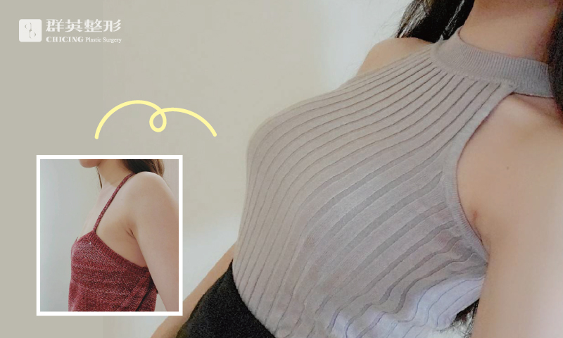 陳廣得醫師_魔滴隆乳案例
