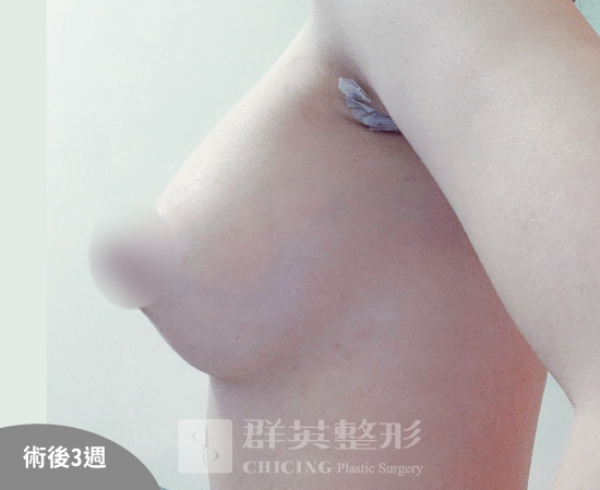 高雄群英_姚勝發醫師_光滑面果凍隆乳27
