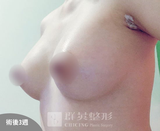 高雄群英_姚勝發醫師_光滑面果凍隆乳26