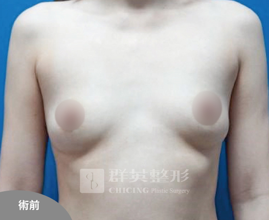 高雄群英_姚勝發醫師_光滑面果凍隆乳51