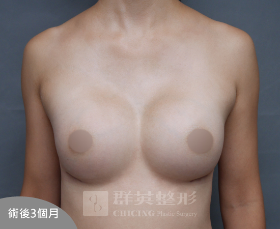 台北群英_黃馨慧醫師_魔滴隆乳38